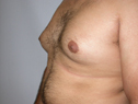 before male breast enlargement